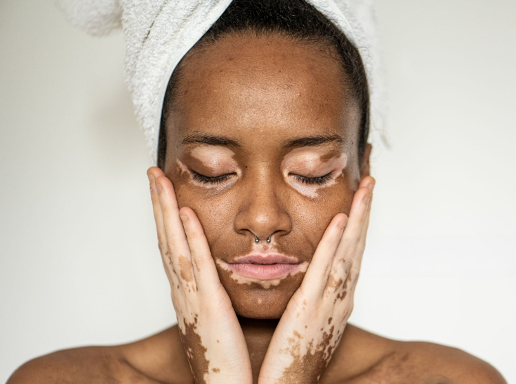 Vitiligo Surgery